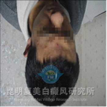 张明治疗后_副本.jpg