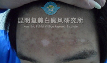 治疗后_副本.jpg